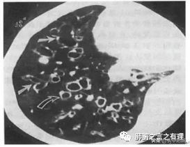 鱼腥草治支气管扩张,支气管扩张科普论文