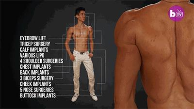 隆胸那些事你真的了解吗,隆胸加腹壁整形