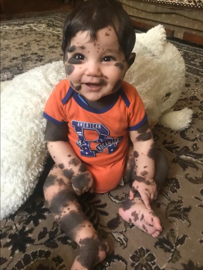 亚美尼亚男童全身布满黑色胎记，医生劝放弃，父母：他是上帝的礼物