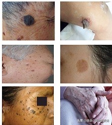 老年斑应该怎么预防,老年斑有办法预防