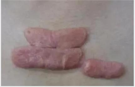 恩泽医院治疗疤痕疙瘩,全国最权威做疤痕疙瘩医院