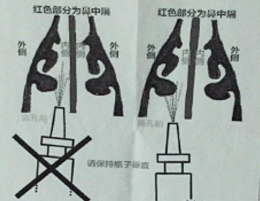 过敏性鼻炎，有什么好办法把你给治了？
