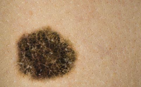 什么样的色素痣必须手术切除,色素痣怎么治疗呢