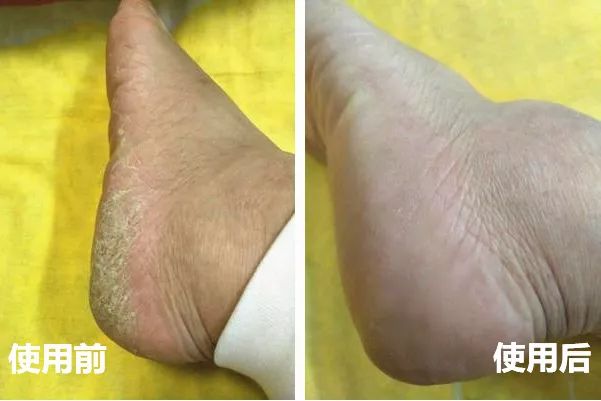手脚干裂倒刺怎么治疗,手脚经常脱皮开裂最佳治疗方法