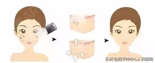 激光护理后防晒,激光护理皮肤