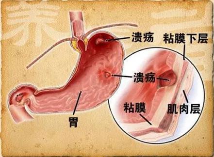 要命的胃出血，一旦出现，怎么办？