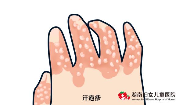 小孩夏天怎么防止痒疹,夏天的宝宝怎么避免热疹