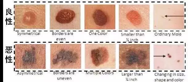 一招让你去掉黑痣,怎么才有效的去除黑痣