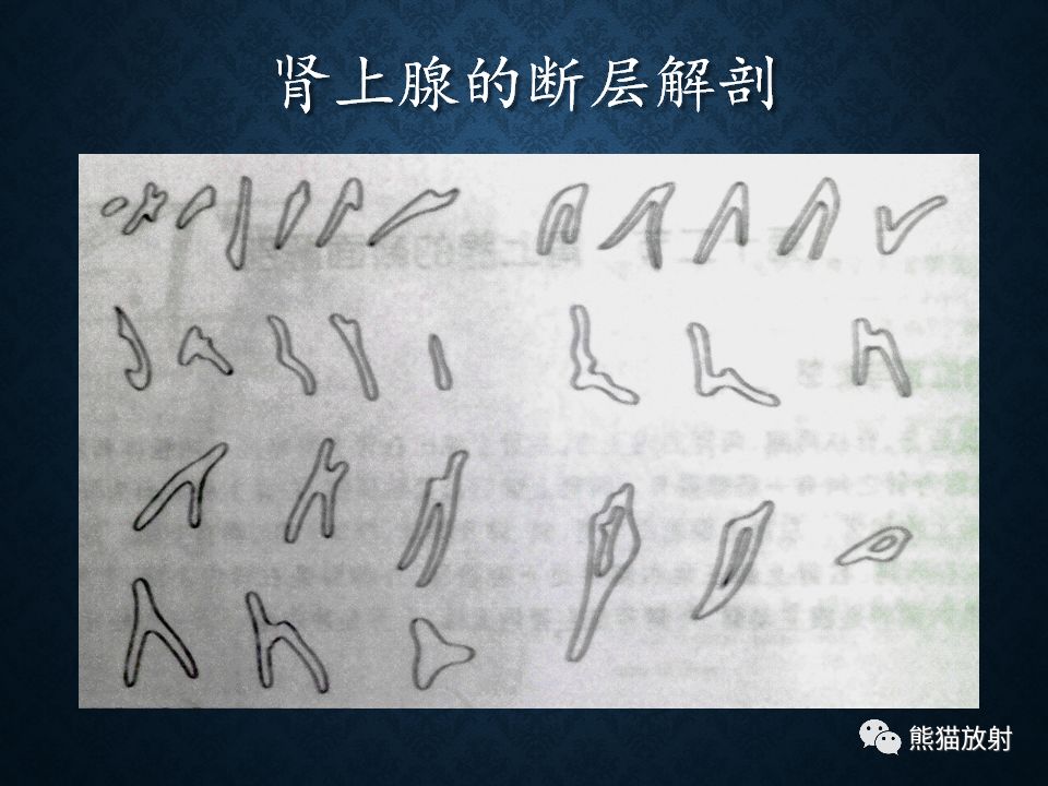 纵隔和肾上腺恶性肿瘤,纵隔性肿瘤位置图