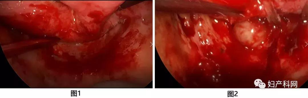 病例分析室|NO.16盆腔脓肿病案分析