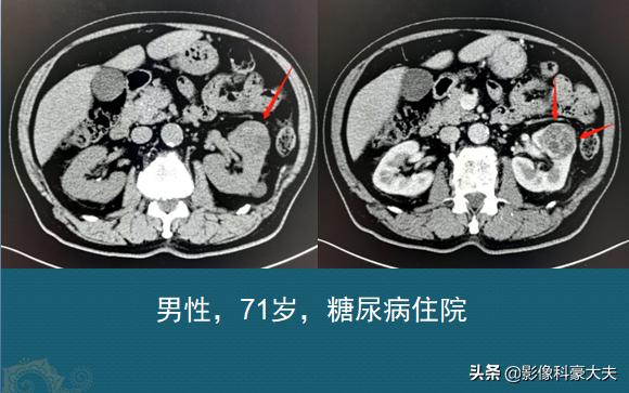 为什么腰部骨折要做心电图,骨折为什么要拍脑ct