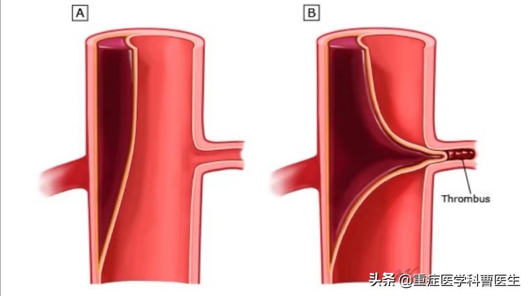 降压药不能擅自停服,降压药吃了不能吃啥