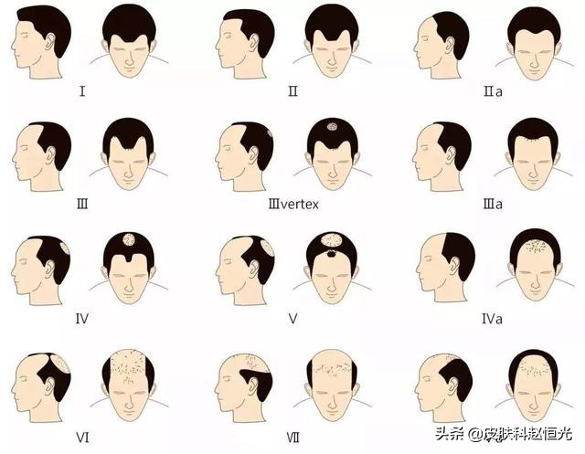 脱发不可挽救吗,脱发没有根治办法吗