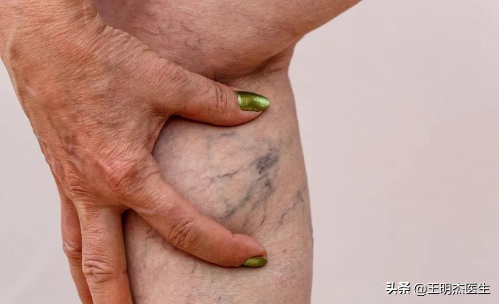 深静脉血栓几年能治好吗,静脉血栓住院治疗需多久可以治好