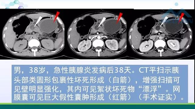 急性胰腺炎的护理措施,急性胰腺炎影像与临床