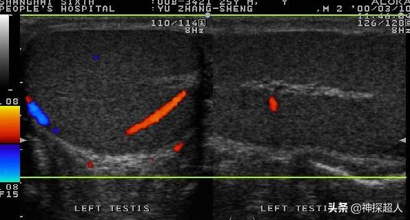 男性“蛋蛋”痛，必须引起重视，特别是一侧突发痛