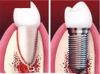 连缺三颗下门牙怎么镶好,明明缺一颗牙为什么要套三颗