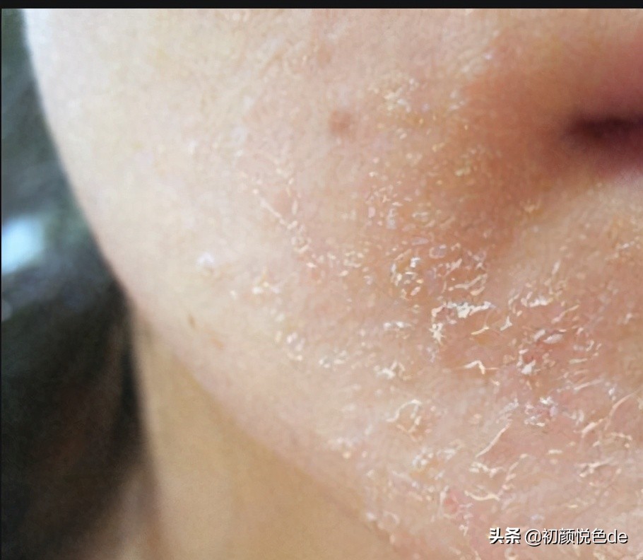 干皮用什么比较温和的护肤品好,干皮补水保湿水排行榜10强