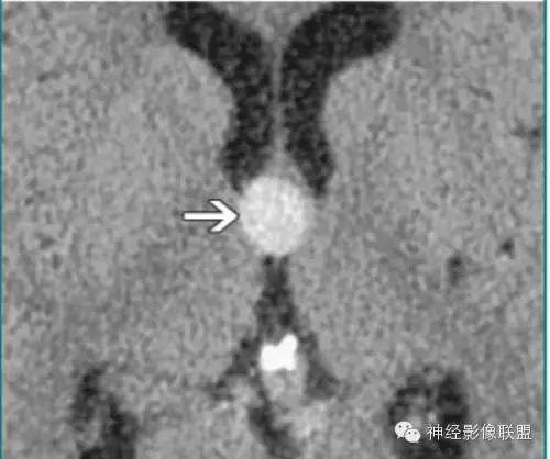 各种囊肿的症状,颅内囊肿18-19mm严重吗