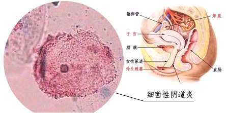 女性各种阴道炎的用药和症状,女性阴道炎的症状及治疗