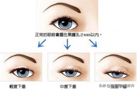 下眼皮松弛祛松皮后会回缩吗,上眼皮松弛下垂怎么办不用眼霜