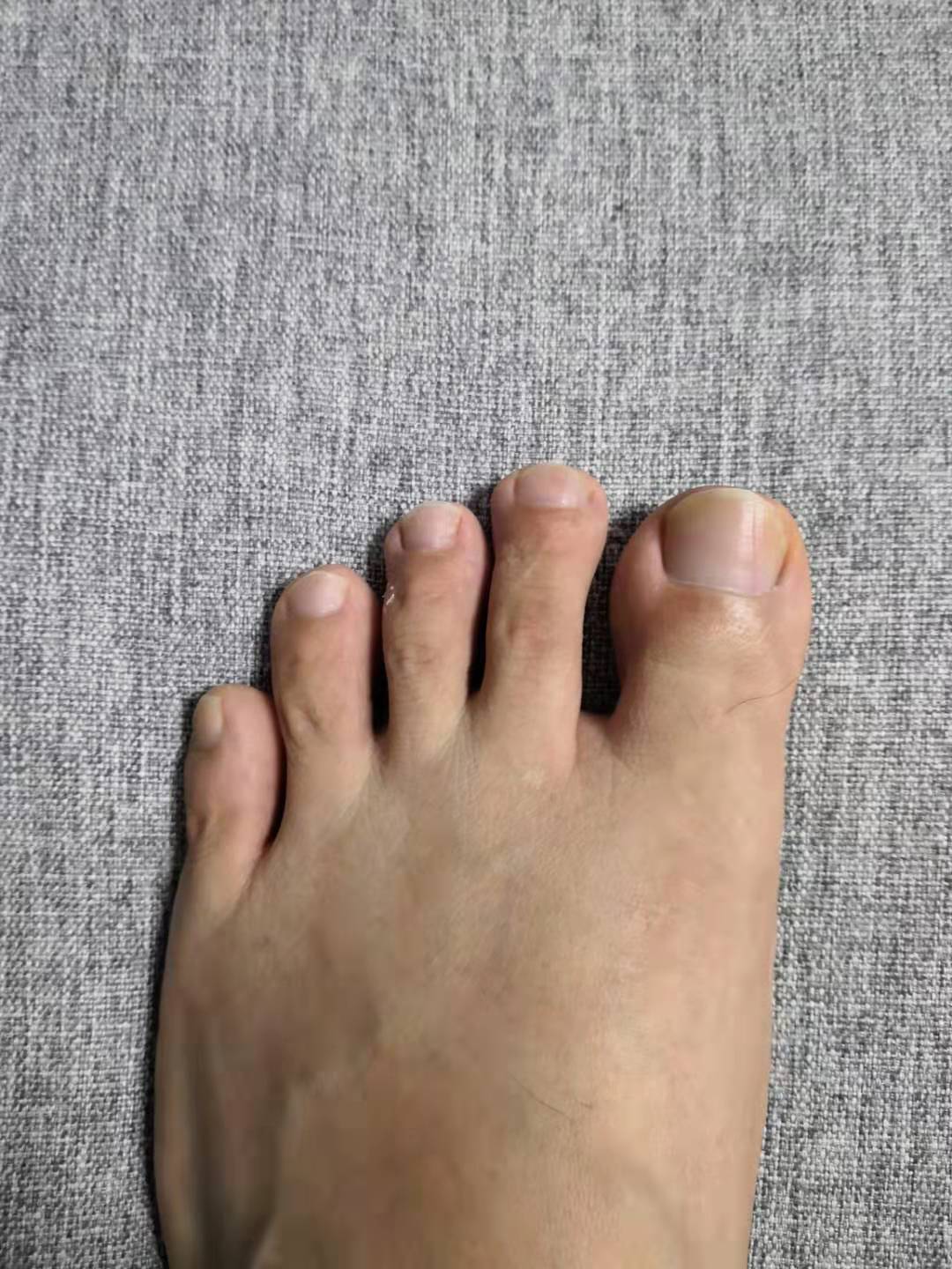 摆脱甲沟炎的痛苦之后的感想,甲沟炎的亲身经历