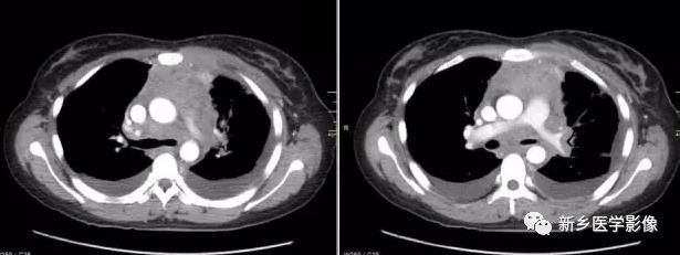 胸腺增生和纵隔肿瘤的区别和症状,纵隔胸腺肿瘤的常见临床症状表现