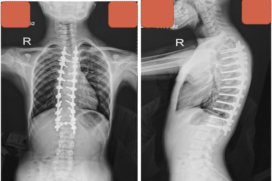 儿童脊髓空洞加脊柱侧弯,合并脊髓空洞的先天性脊柱侧弯