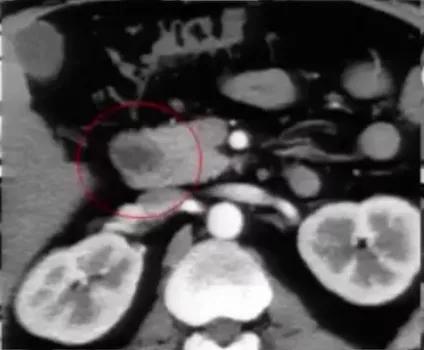 腹部ct详细讲解,腹部ct示意图及超详细教学