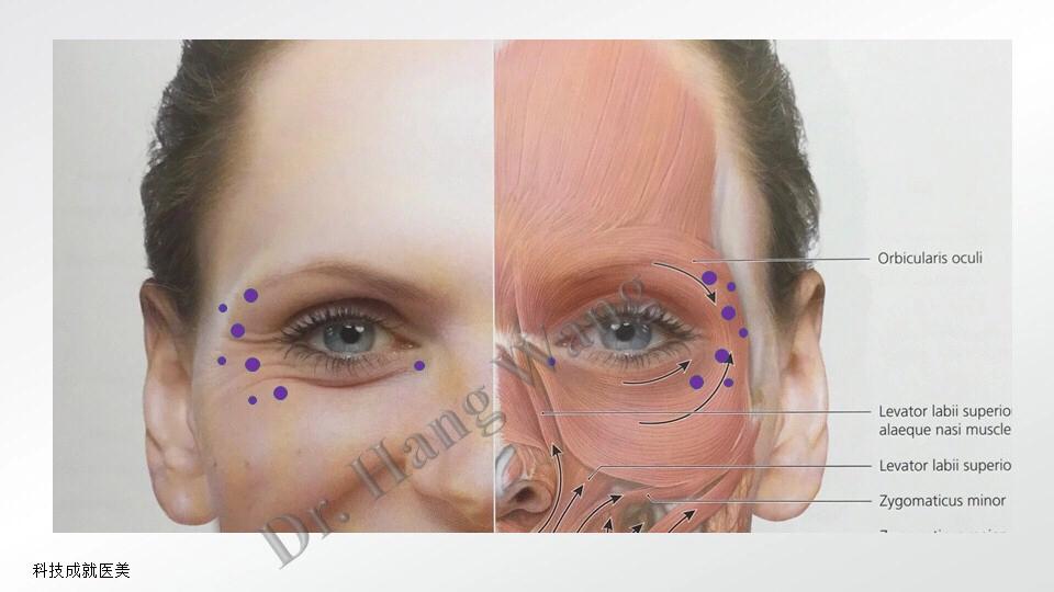 美帕涂抹型肉毒素精华液,美帕抗老精华