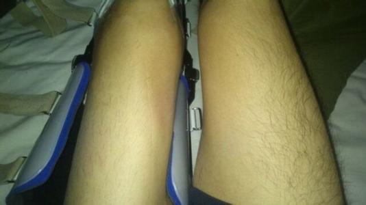 colles骨折石膏固定注意事项,骨折石膏外固定后改变是什么意思