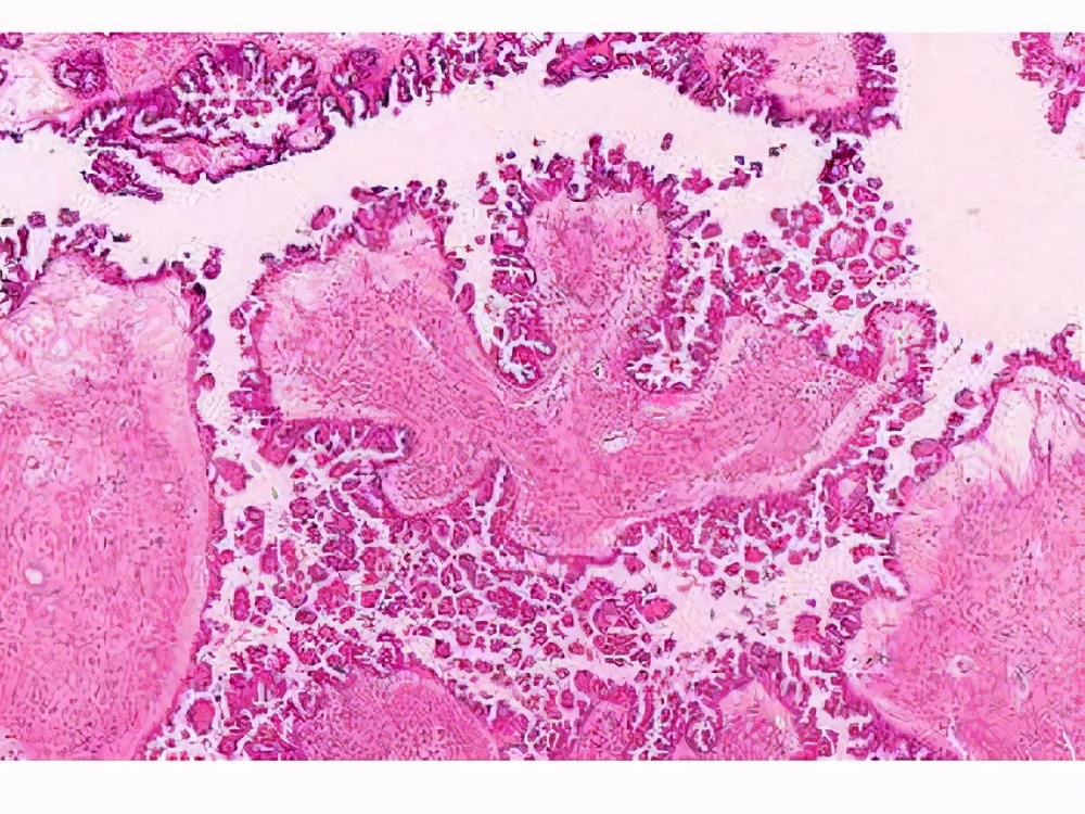 为什么交界性肿瘤不赔了,交界性肿瘤在理赔时算恶性吗