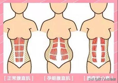 产后耻骨分离瑜伽矫正动作,产后腹直肌分离修复手法教程