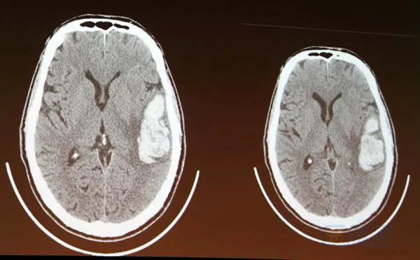 脑出血是开颅好还是引流好,脑出血是手术好还是保守治疗好