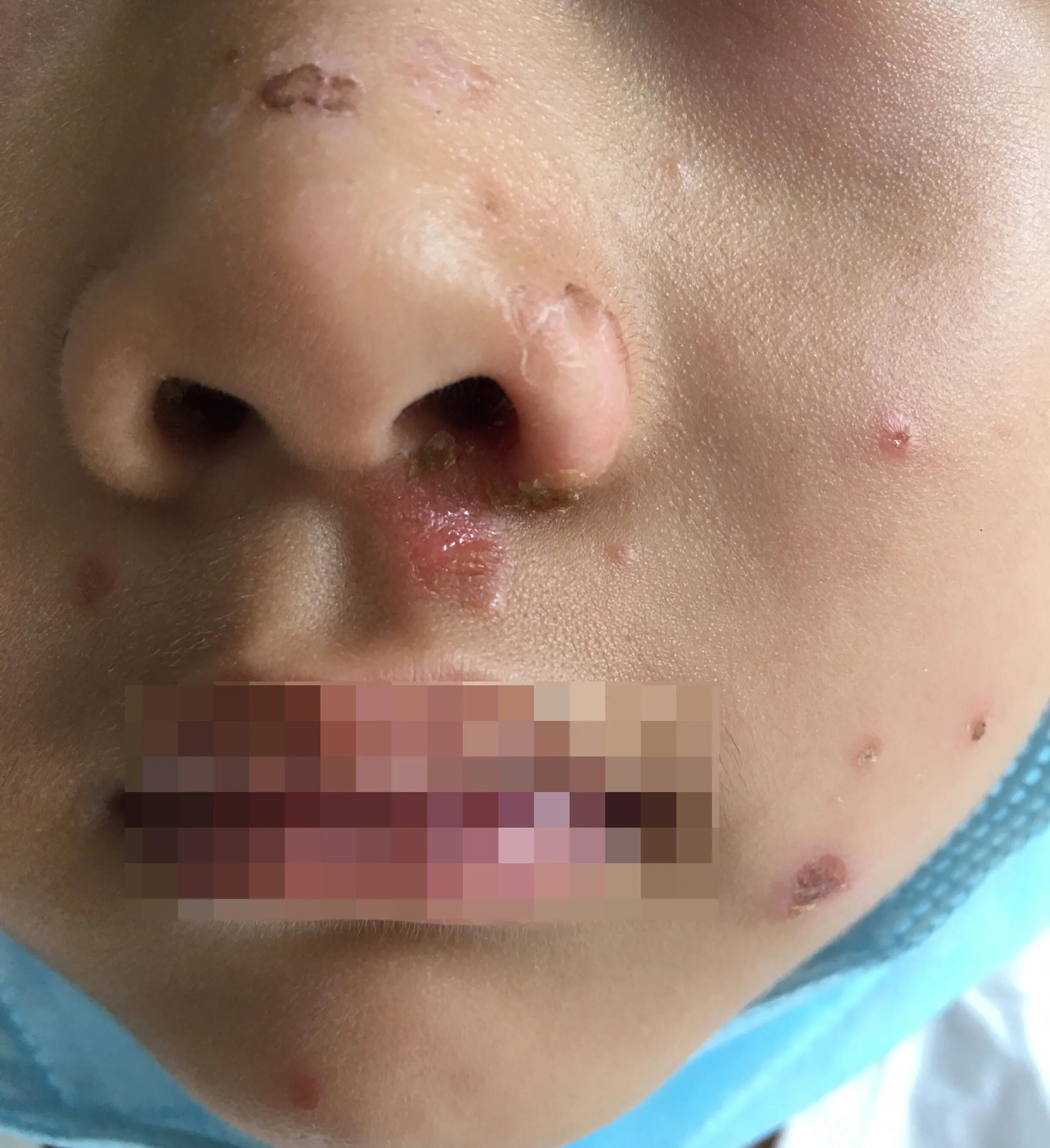 儿童面部黄水疮症状,黄水疮的鉴别方法