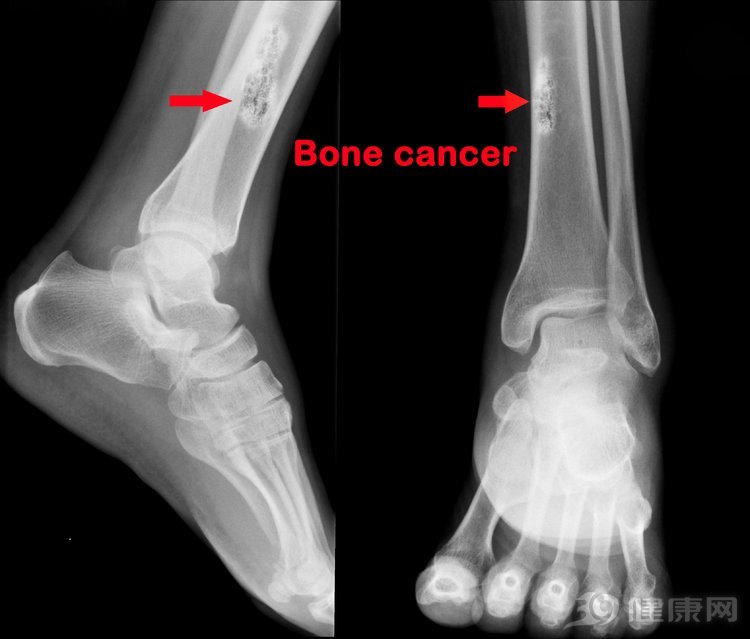 女孩腿疼是癌症的前兆吗,半夜腿痛的厉害是怎么回事骨癌
