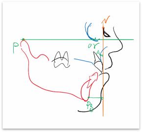 骨性龅牙和牙性龅牙的区别,牙性龅牙和骨性龅牙怎么矫正