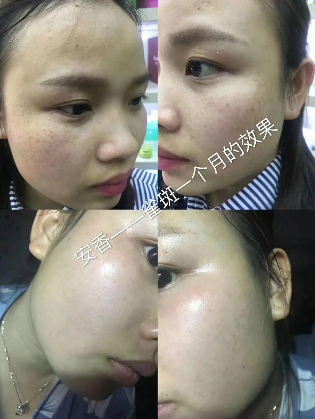 遗传性雀斑食疗方法,遗传性雀斑祛斑霜