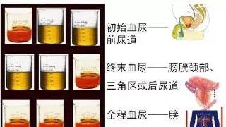 女人突然尿频尿痛尿血,突然尿血尿频尿疼是怎么回事