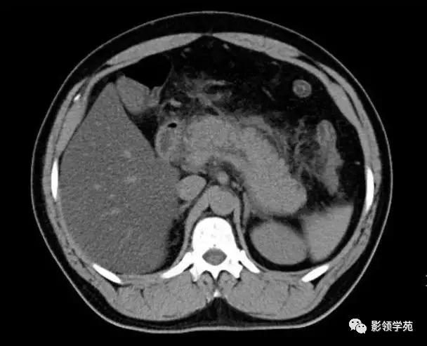 16种常见急性腹痛的诊断与鉴别