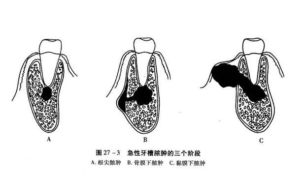 牙龈肿痛一招教你,牙龈肿痛中医教你一招自愈