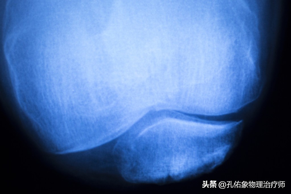 膝关节痛骨性关节炎的治疗方法,膝骨性关节炎的手法治疗视频