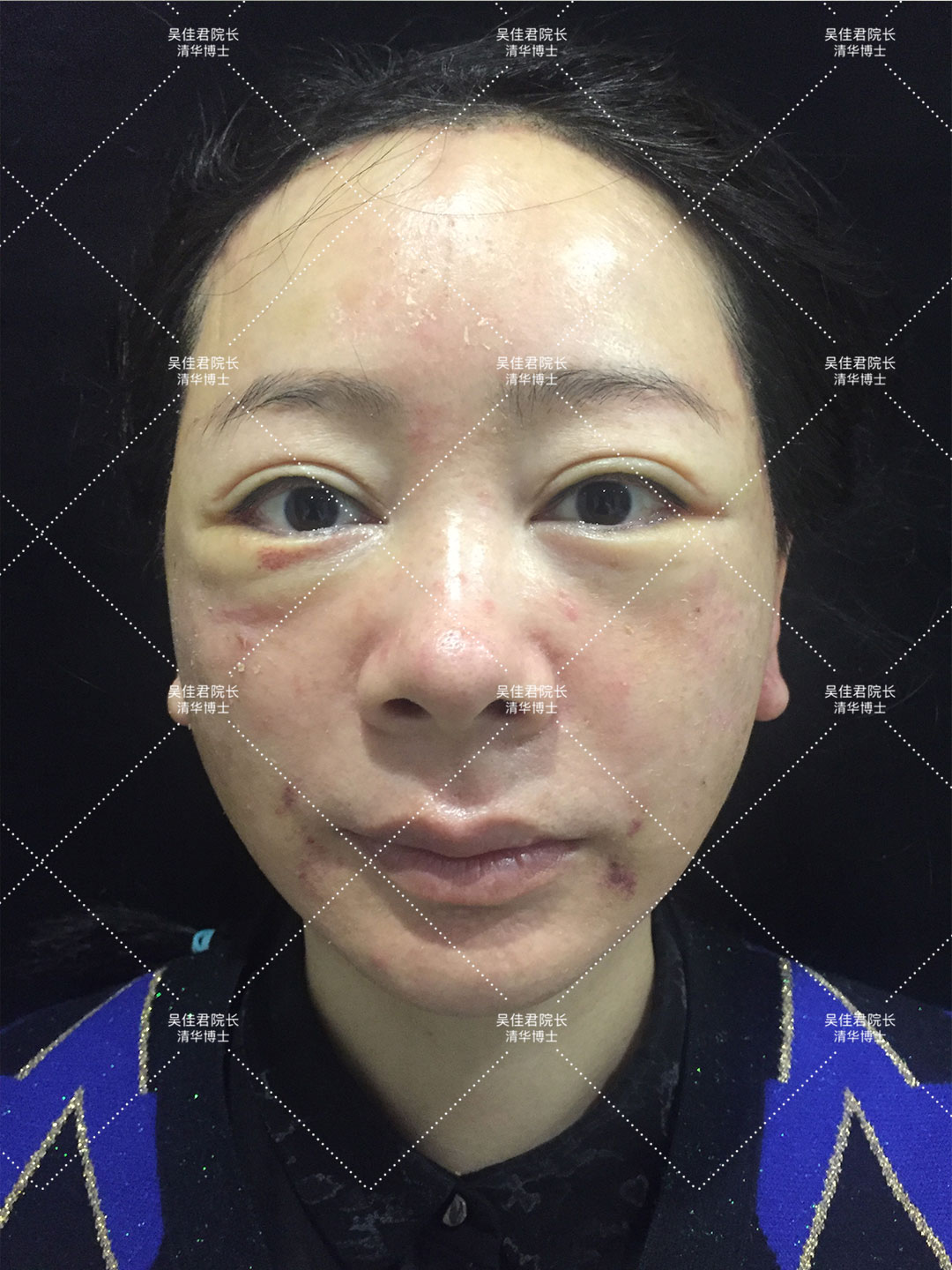 拉皮手术会加速衰老吗亲身经历,40多岁做小拉皮术后6个月