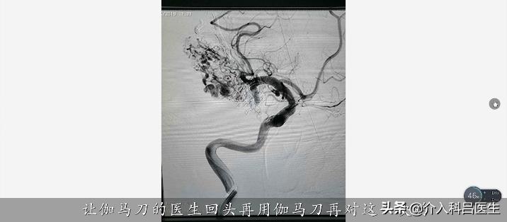 53岁先天性动静脉畸形导致脑出血,50岁大姐脑梗