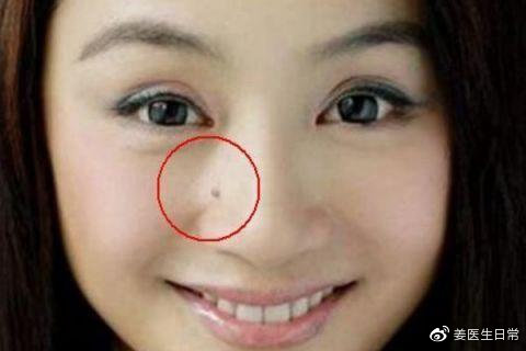 想把脸上的痣去掉去医院哪个科,脸上危险三角区的痣可以去掉吗