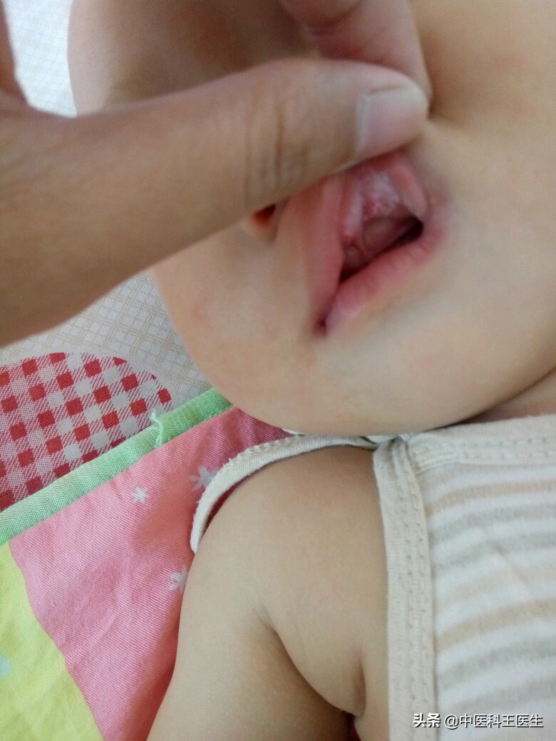 婴儿鹅口疮反复复发怎么办,氟康唑注射液治疗鹅口疮会复发吗