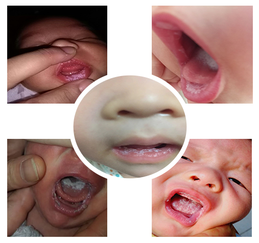 鹅口疮反反复复的怎么办,鹅口疮反反复复怎么才能彻底