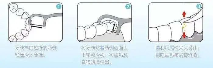 牙线使用5步骤轻松有效去牙垢,好好刷牙可以治疗牙周病么