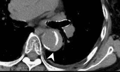 如何监测动脉夹层早期,动脉增强ct能查出主动脉夹层么