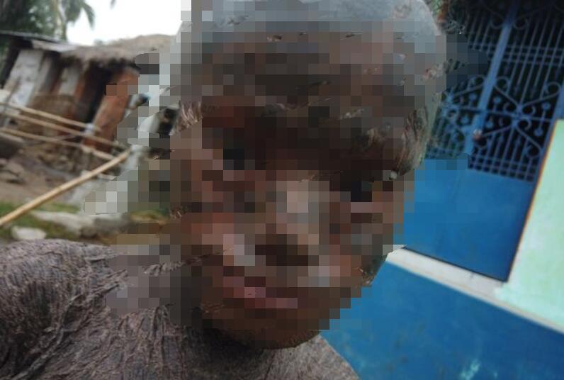 印度男孩患怪病正慢慢变成石头人,印度男孩患罕见疾病